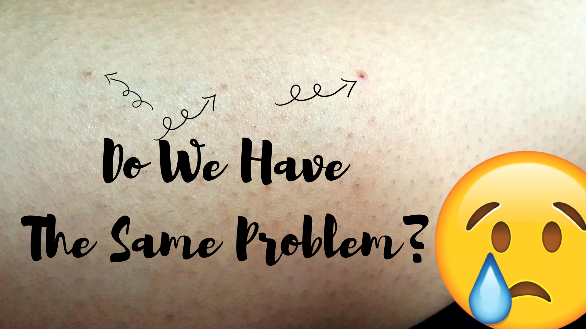 What To Do About Ingrown Hair On Legs | The Practical Beauty